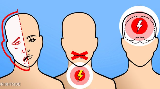 Инсултът не се случва внезапно! Ето всичко което трябва да знаете за него и как да го предотвратите!