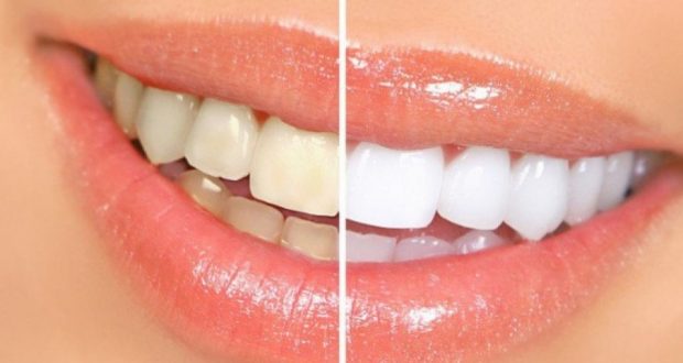 Как да избелим зъбите с няколко нюанса