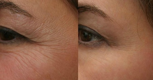 Мехлем-чудо против бръчки с траен ботокс-ефект