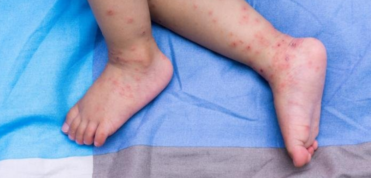 Дете от Франция докарало морбили