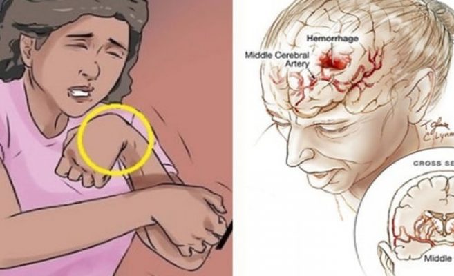 Първи и много важни симптоми на инсулт: В никакъв случай не ги игнорирайте!
