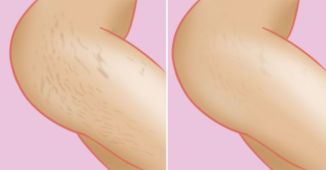 Бяхме на плажа: гледам няма стрии а роди наскоро! Откъде пари за лазер? Много просто не било лазер а домашно мехлемче: