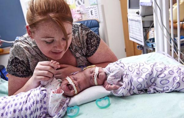 Тези близначки се родили със сраснали глави. Ето как изглеждат днес