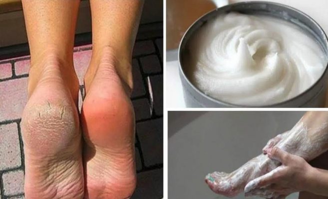 2 пъти седмично и петичките стават нежни като бебешко дупе до морето – убива гъбичките премахва мазолите