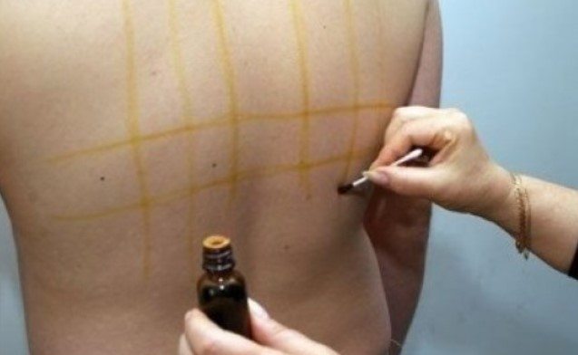 Майка ми рисуваше квадрати с йод на гърба на баща ми. Като разбрах причината веднага я помолих да го направи и на мен