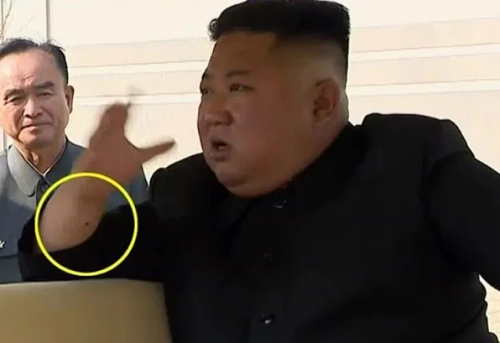 Медици видяха нещо на ръката на Ким Чен Ун