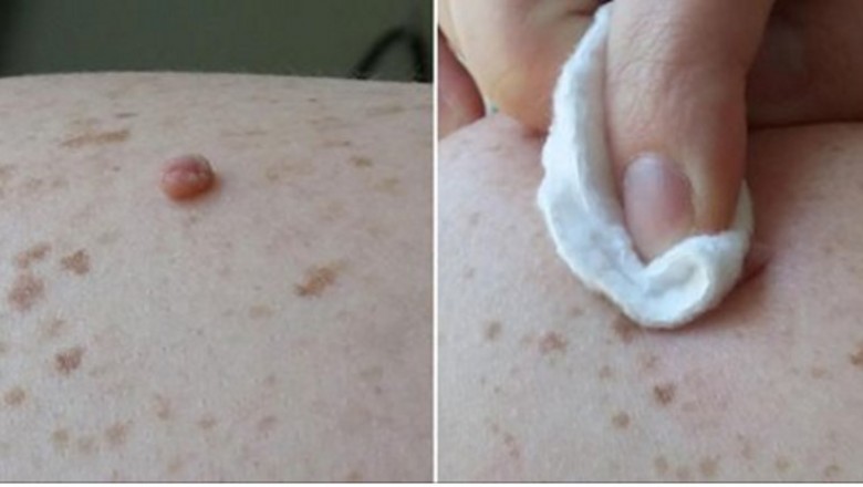 Една колежка ми сподели тази рецепта- само за 48 часа брадавиците