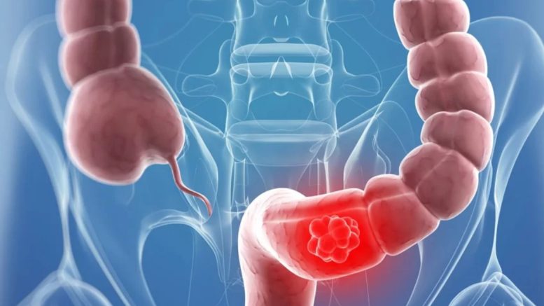 Имате ли този тих симптом, веднага на преглед при онколог