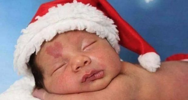 Как изглежда днес момчето което се роди с родилно петно във формата на сърце на челото