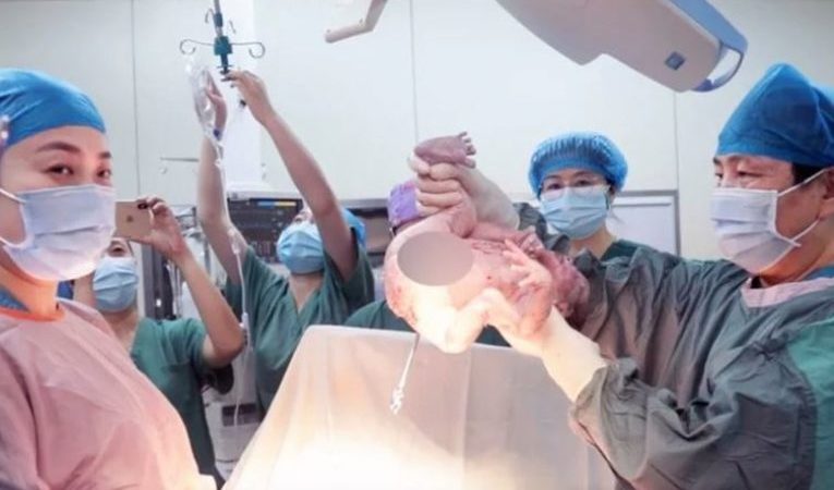 Жена роди близнаци с 10 години разлика