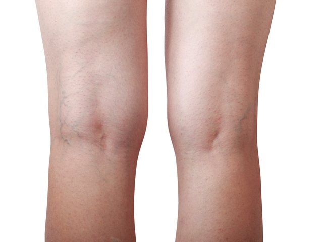Разширени вени – 4 рецепти за лечение от народната медицина