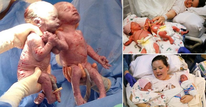 Помните ли бебетата които се родиха държащи се за ръце – Ето изглеждат днес!