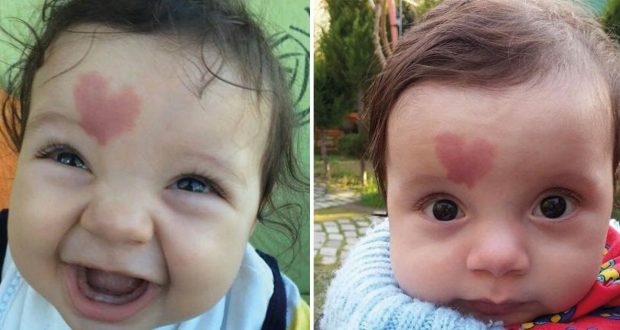 Помните ли бебчето което се роди с белег под формата на сърце?