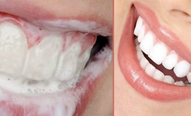 Oтървете се от зъбния камък с тази простичка рецепта