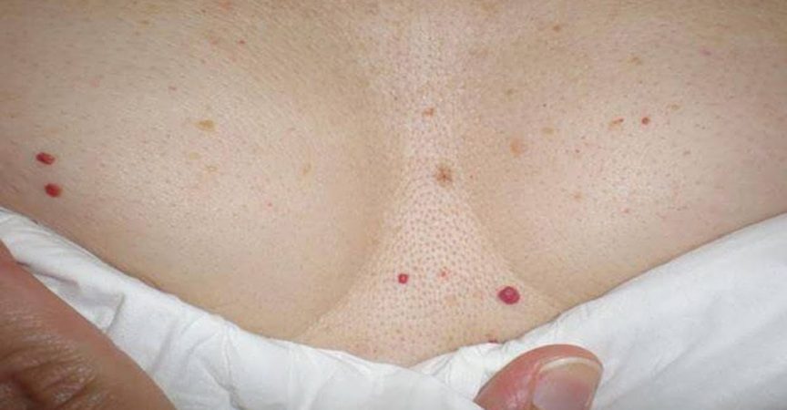 Имате ли подобни червени бенки по тялото? Вижте какво означава това!
