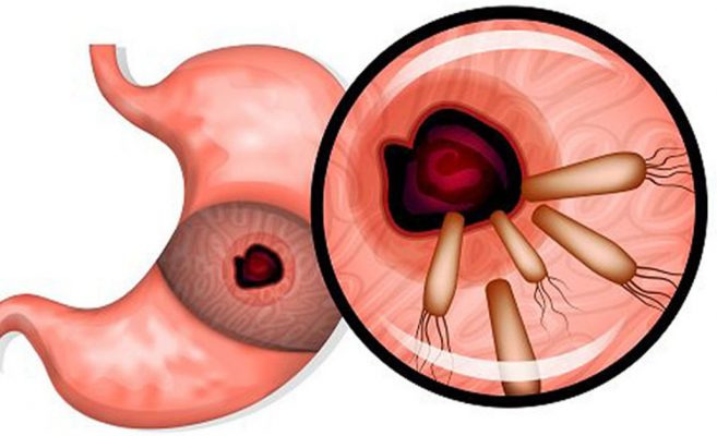 Отървах се от гастрит който лекувах 5 години!